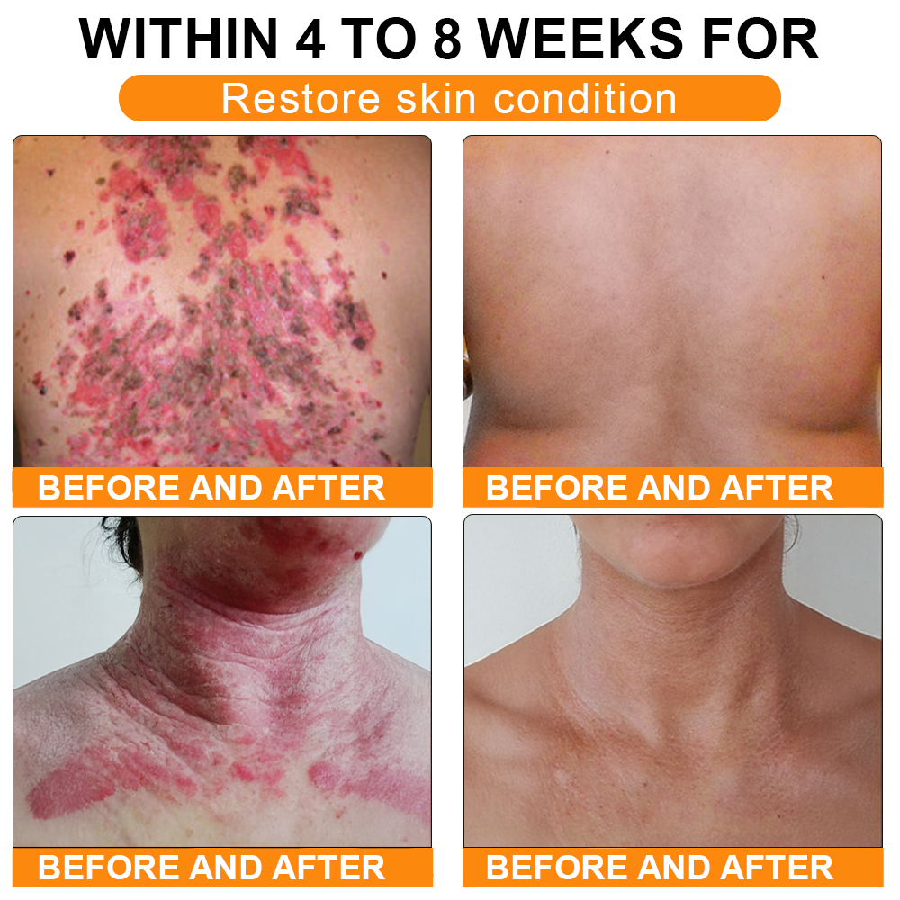 🏥A professional team of dermatologists has experimentally developed PolarFresh® Tallow Bee Venom Skin Restoration Cream – Repairs and protects, preventing recurrence