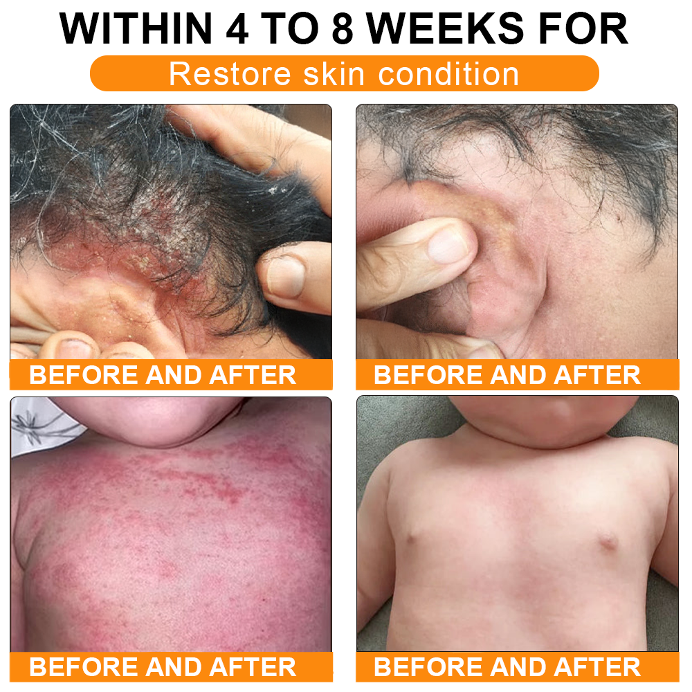 🏥A professional team of dermatologists has experimentally developed PolarFresh® Tallow Bee Venom Skin Restoration Cream – Repairs and protects, preventing recurrence