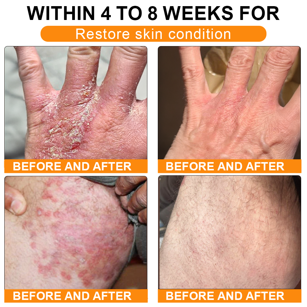 🏥A professional team of dermatologists has experimentally developed PolarFresh® Tallow Bee Venom Skin Restoration Cream – Repairs and protects, preventing recurrence