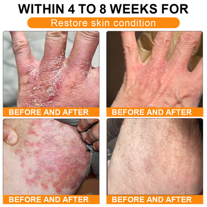🏥A professional team of dermatologists has experimentally developed PolarFresh® Tallow Bee Venom Skin Restoration Cream – Repairs and protects, preventing recurrence