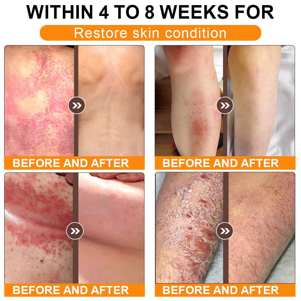 🏥A professional team of dermatologists has experimentally developed PolarFresh® Tallow Bee Venom Skin Restoration Cream – Repairs and protects, preventing recurrence