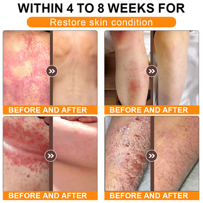 🏥A professional team of dermatologists has experimentally developed PolarFresh® Tallow Bee Venom Skin Restoration Cream – Repairs and protects, preventing recurrence