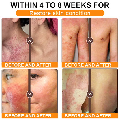 🏥A professional team of dermatologists has experimentally developed PolarFresh® Tallow Bee Venom Skin Restoration Cream – Repairs and protects, preventing recurrence