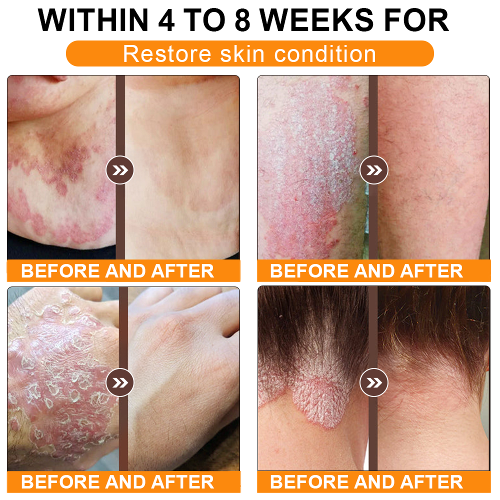 🏥A professional team of dermatologists has experimentally developed PolarFresh® Tallow Bee Venom Skin Restoration Cream – Repairs and protects, preventing recurrence