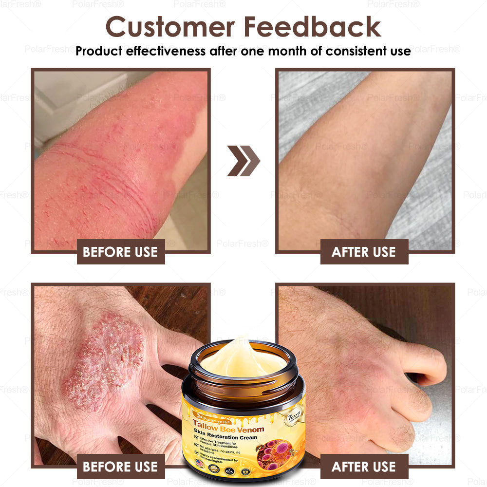 🏥A professional team of dermatologists has experimentally developed PolarFresh® Tallow Bee Venom Skin Restoration Cream – Repairs and protects, preventing recurrence