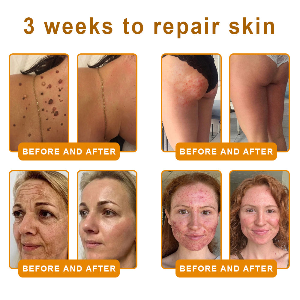 🏥A professional team of dermatologists has experimentally developed PolarFresh® Tallow Bee Venom Skin Restoration Cream – Repairs and protects, preventing recurrence